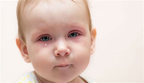 bebeklerde göz nezlesine ne iyi gelir